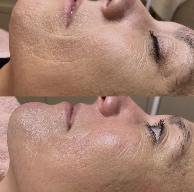 Huid voor en na dermaplaning