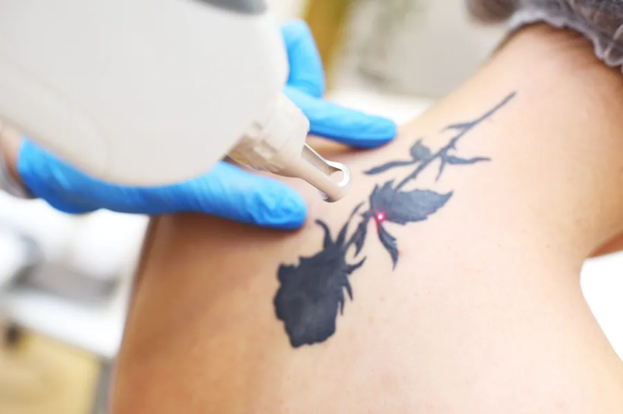 Specialist behandelt een tatoeage met de laser